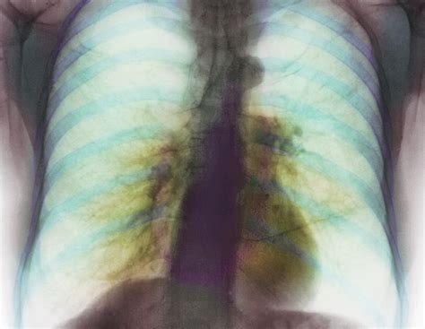 Pulmonary Emphysema, X-ray Photograph by Cnri - Pixels