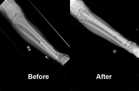 Treatment of Nonunion and Malunion - Penn Medicine