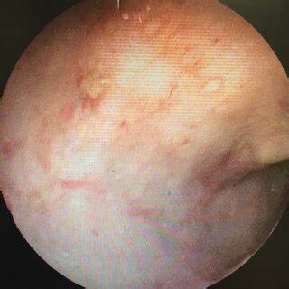 Colonoscopy showing the presence of small angiodysplasia lesions in the ...