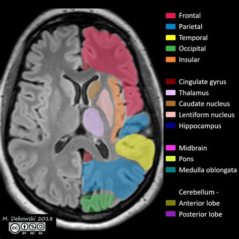 Brain lobes - annotated MRI (Radiopaedia 61691-69700 Axial) - NC Commons