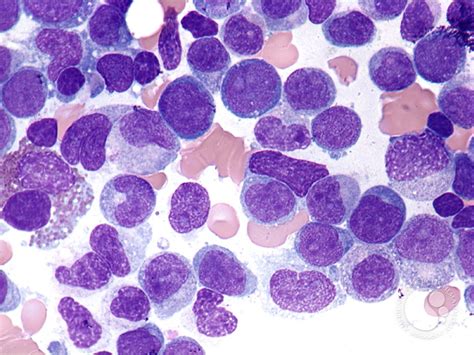 Acute myelomonocytic leukemia - 3.