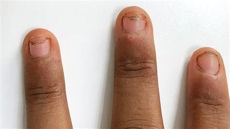 Nail Bed Receding Causes - My Bios