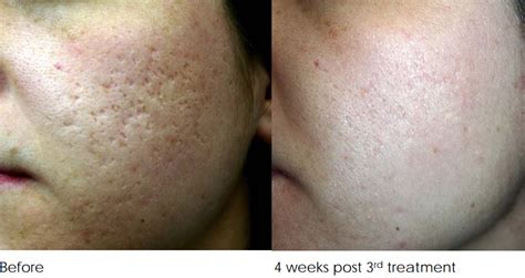 acne-scar-removal-treatment-melbourne-before-and-after-3-treatments ...