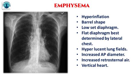 Emphysema Vs Normal Chest X Ray