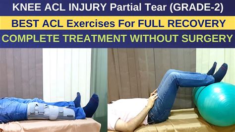 Treatment of ACL Injury Partial Tear-Grade 2, ACL Rehab Exercises ...