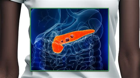 Case Study: Stage IV Precision Pancreatic Adenocarcinoma Cancer ...