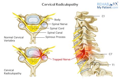 Xray pinched nerve in neck - tewsquiz