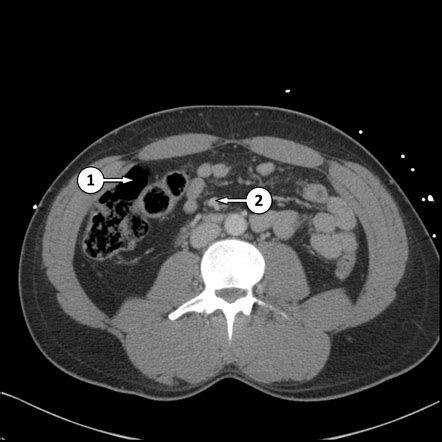 CT abdomen/pelvis (lower) axial - labelling questions | Radiology Case ...