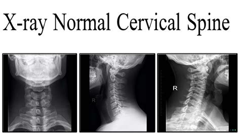 Healthy Cervical Spine Xray