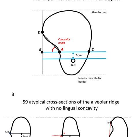 Illustration and classification of cross-sections of the alveolar ridge ...