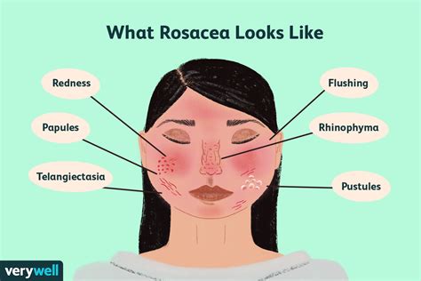 Diagnosis of Rosacea