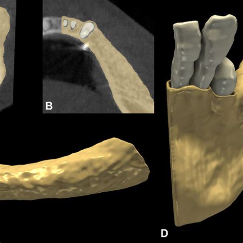 6-month follow-up alveolar ridge morphology. A: Sagittal alveolar ridge ...