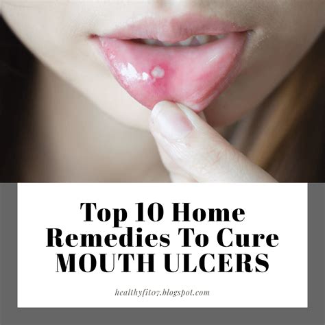 Top 10 Home Remedies To Cure MOUTH ULCERS