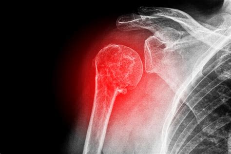 Joint Dislocations: Causes, Symptoms, Treatment and Exercises ...