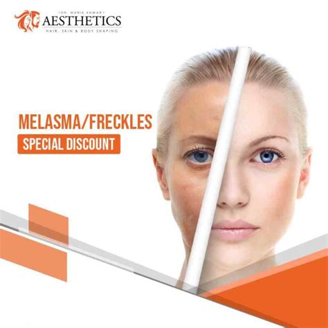 Melasma Treatment - Dr Waris Anwar Aesthetics