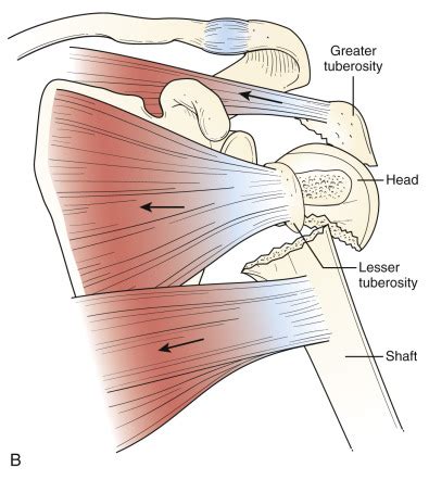 Fractures of the Proximal Humerus | Musculoskeletal Key