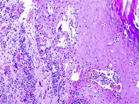 Acral Lentiginous Melanoma Histology