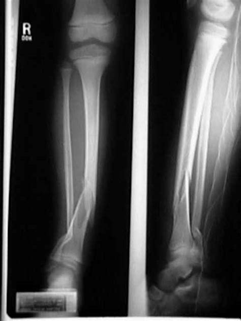 Pediatric Tibial Fracture : Wheeless' Textbook of Orthopaedics