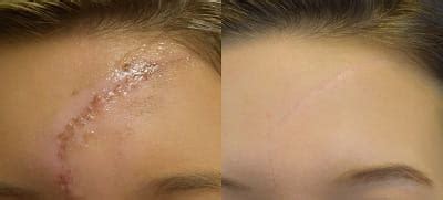 Scar Revision & Keloid Treatment | MUSC Health | Charleston SC