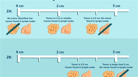 Brain Tumor Size Chart Cm - Best Picture Of Chart Anyimage.Org