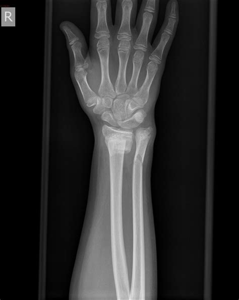 Forearm X Ray Anatomy