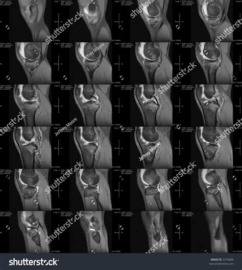 Mri Scan Of A Knee. Stock Photo 2315009 : Shutterstock