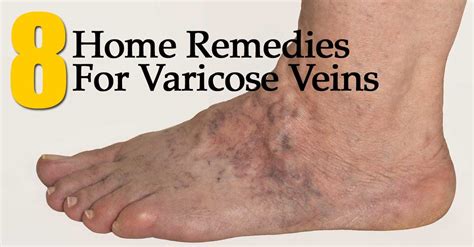 8 Home Remedies For Varicose Veins