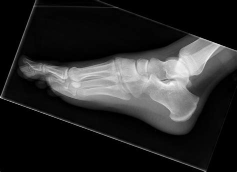 Navicular fracture | Radiology Reference Article | Radiopaedia.org ...