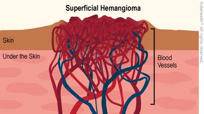 Infantile Hemangiomas (for Parents) | Nemours KidsHealth