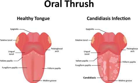 Oral Candidiasis (Oral thrush) - Fungal Infections - AntiinfectiveMeds.com