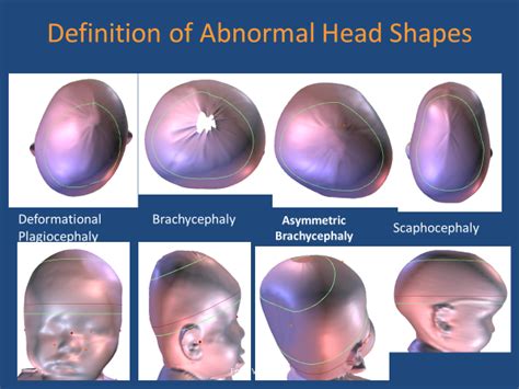 Head Shape Evaluation Clinic - Childrens Faces