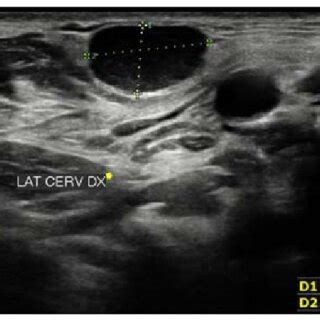 Neck ultrasound illustrating enlarged lymph nodes. | Download ...