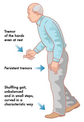 Symptoms and Signs of Parkinson’s disease - HealthNormal