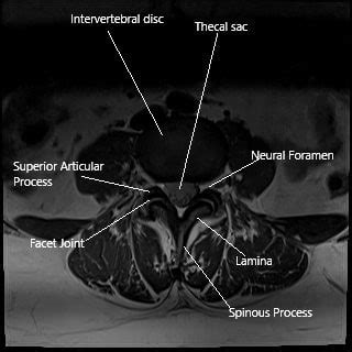 Synovial Facet Cyst - Complete Orthopedics | Multiple NY Locations