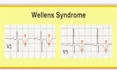 Rare Case of Wellens syndrome progressing from type A to classic type B ...