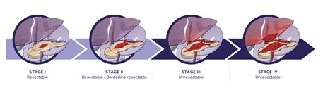 Stages Of Pancreatic Cancer