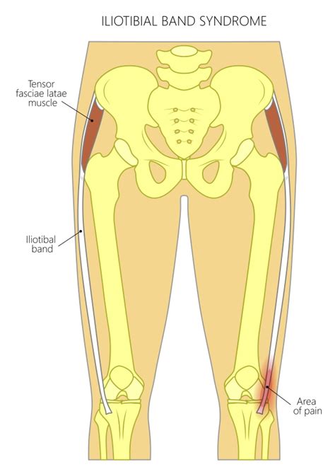 Cortisone injection for IT band syndrome: Is it worth it?