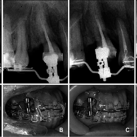 (PDF) Orthodontic treatment of an ankylosed tooth; application of ...