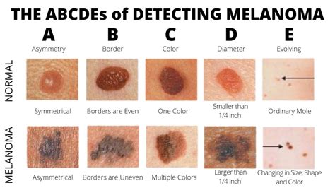 Moles - AIM at Melanoma Foundation