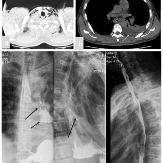 CT scan of the chest revealed subcutaneous and mediastinal emphysema in ...