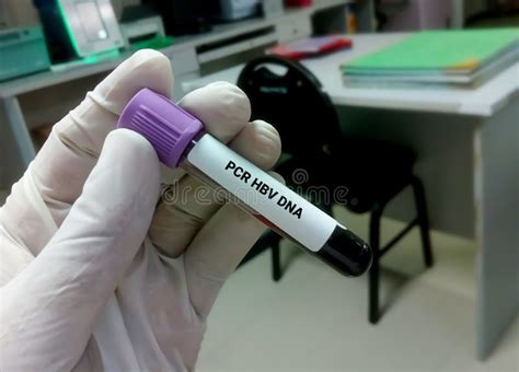 Blood Sample for PCR HBV DNA Test. Hepatitis B Virus Test Stock Photo ...