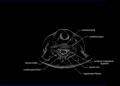 MRI spine anatomy | free MRI axial cervical spine anatomy | Mri ...