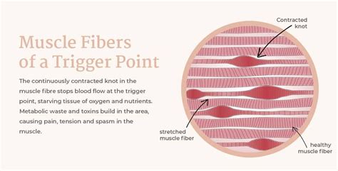 What Is A Muscle Knot, Is There A Way To Treat Them? — West End Wellness