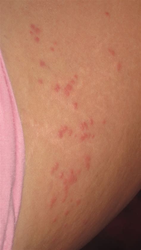 I have small itchy red bumps on my skin, any idea what this can be ...