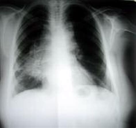 Mediastinal Lymph Node Diagram