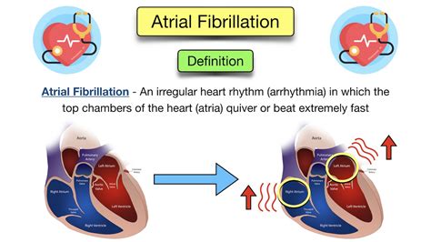 Atrial Fibrillation: Symptoms, ECG, Causes, Treatment, Definition ...