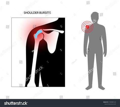 179 Shoulder Bursae Images, Stock Photos & Vectors | Shutterstock