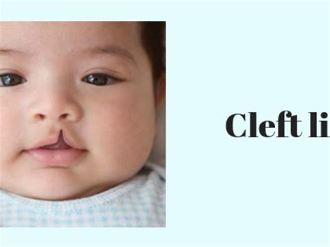 What Causes Cleft Lips In Babies | Lipstutorial.org