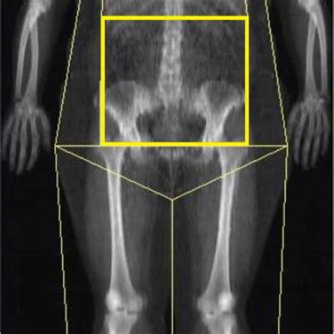 Total body DXA scan with the region of measurement of abdominal fat ...