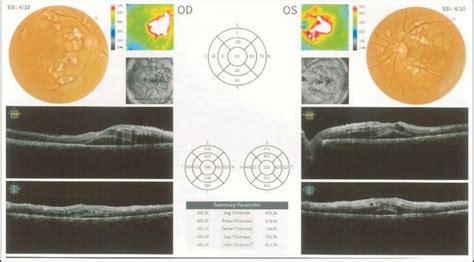 Fundus Picture and OCT scan. (Cotton wool spot with white arrows ...